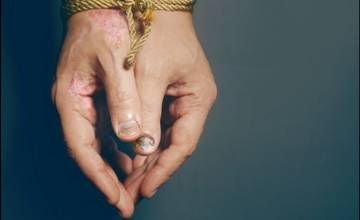 Bezplatné vyšetrenie pre ľudí so psoriázou v Trnave a Skalici už 27. októbra