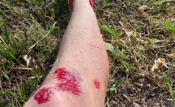 FOTO: Kolobežkár skončil po zrážke s cyklistom v nemocnici